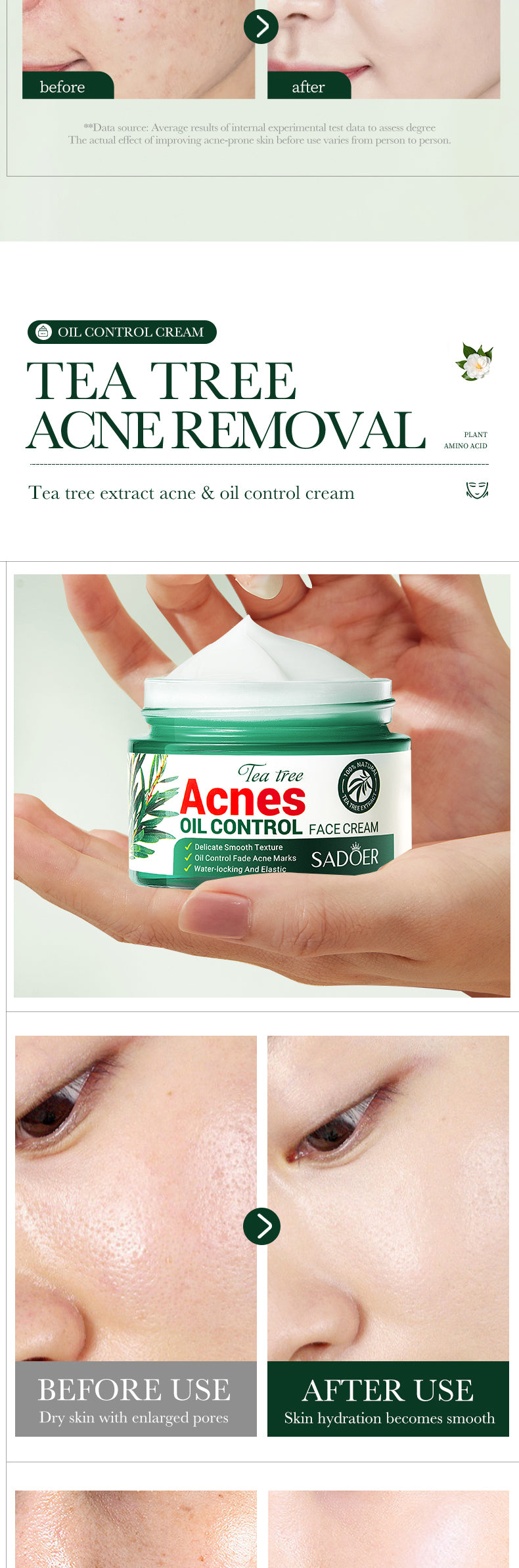 100% Organic Tea Tree Oil Acne Control Face Cream for Smooth Skin Care